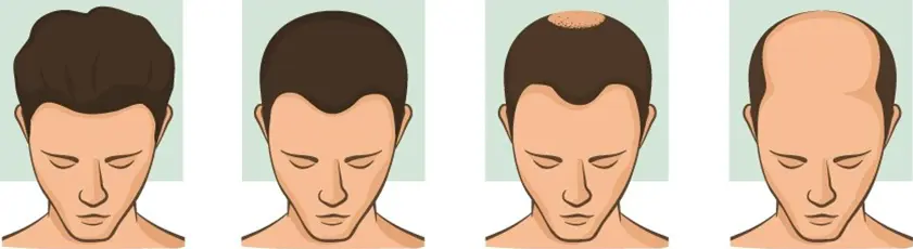 Hair loss imagery male