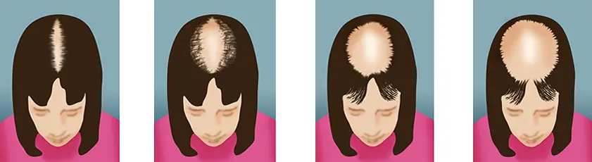 Hair loss imagery female